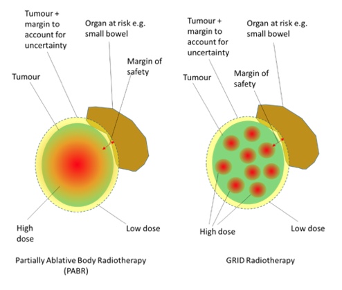 Implementing Spatially-fractionated Radiation Therapy (SFRT) Techniques ...